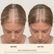 GRO+ Advanced — Dermaroller Stimulant